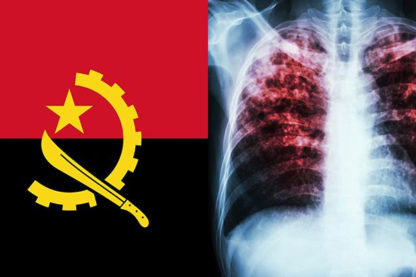 Tuberculosis en Angola: Disminución y Compromiso del Gobierno